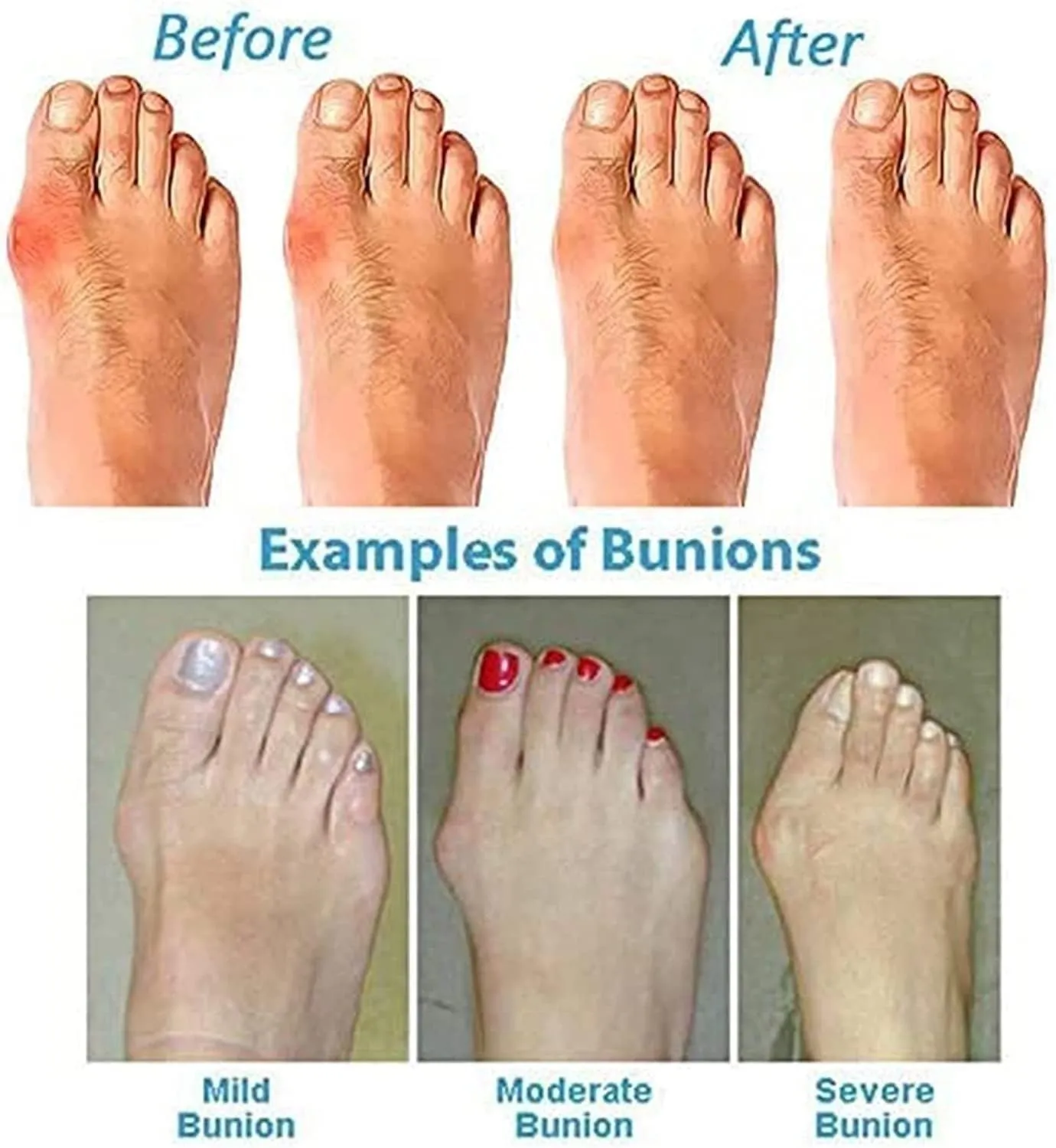 Lightweight Split Toe Bunion Corrector Sandals Men, Summer Breathable Men's Durable Sandals Bunion Relief